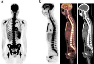 Differential Diagnosis Of Diffuse Bone Marrow Uptake On 18F-FDG PET/ CT ...