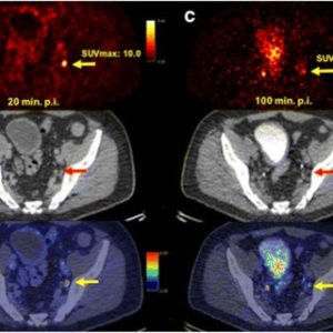 Ga-68-PSMA lyophilized ready to use kit for diagnosis of prostate ...