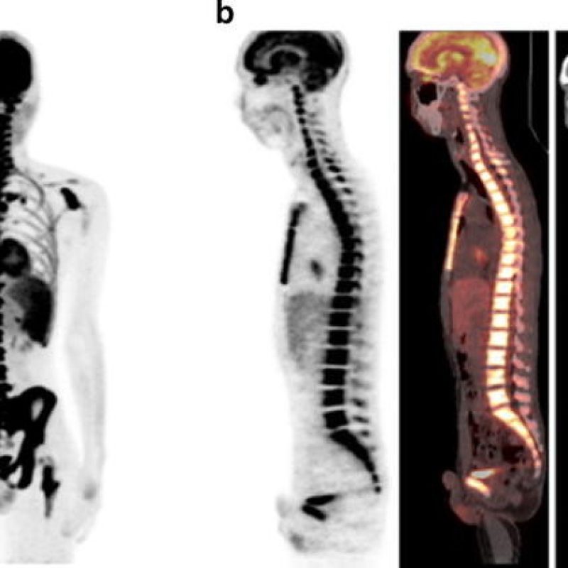 18F-FDG-PET-CT-images-of-a-24-year-old-man-with-B-cell-acute-lymphoblastic-leukemia