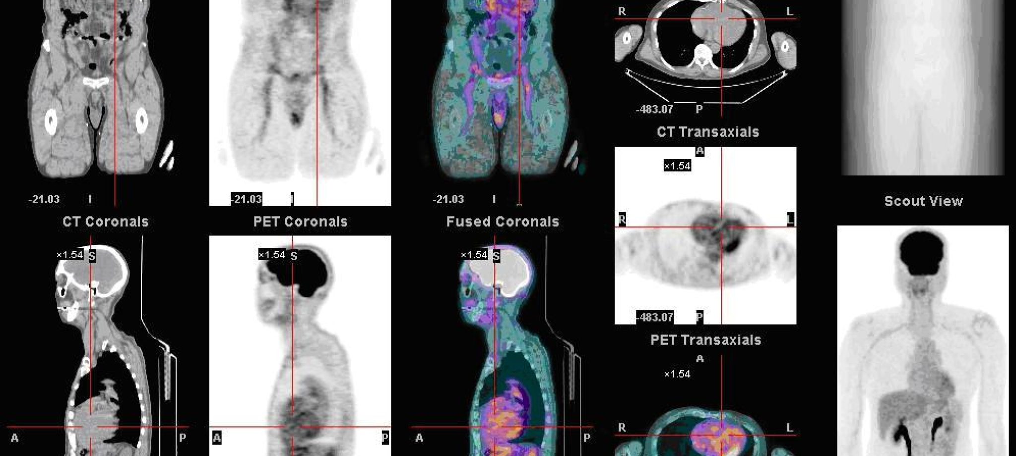 Nl_petct